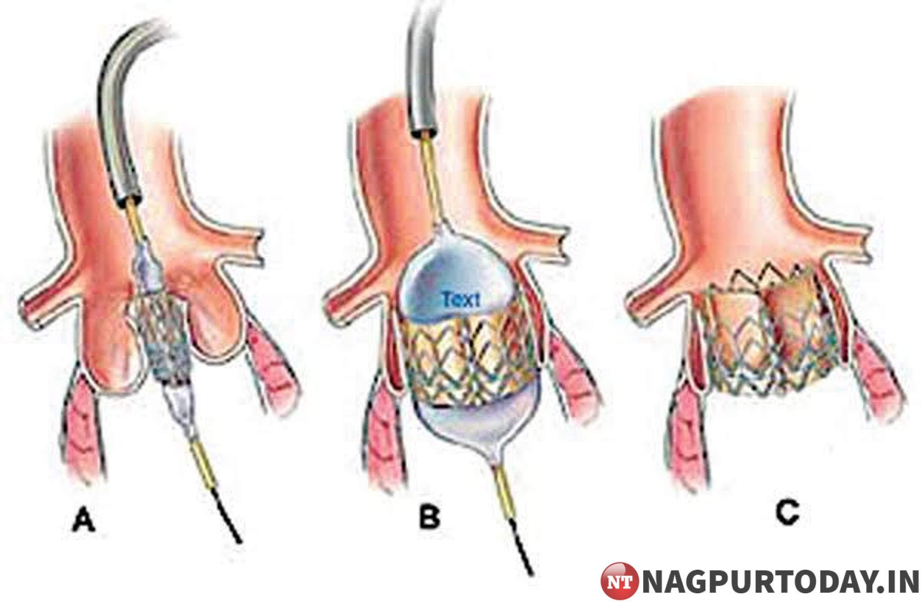 https://www.nagpurtoday.in/wp-content/uploads/2020/09/Image-2.jpg