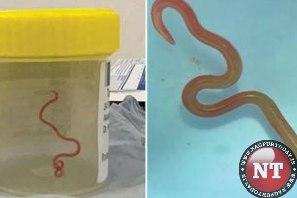 Surgeon Finds Live Wriggling Worm In Womans Brain 